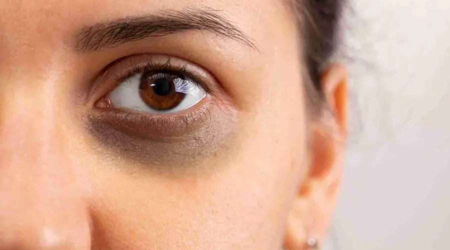 Ankho ke neeche Dark circles ke karan
