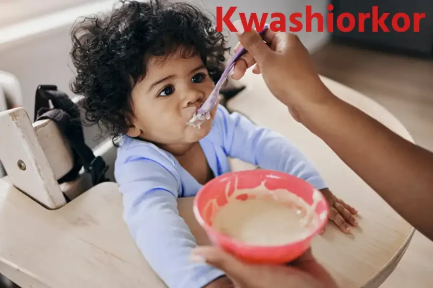kwashiorkor ki roktham santulit aahar aur shiksha ka mahatv