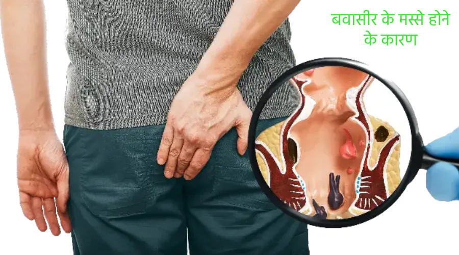 bawasir ke masse ka karan