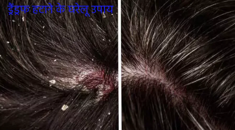 Dandruff hatane ke gharelu upay