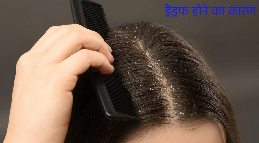 Dandruff hone ke lakshan