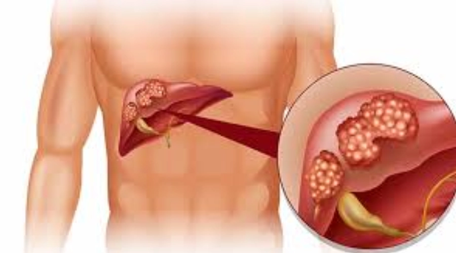Liver mein infection ke karan