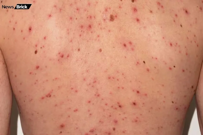 chicken pox se bachav ke gharelu aur asan upay
